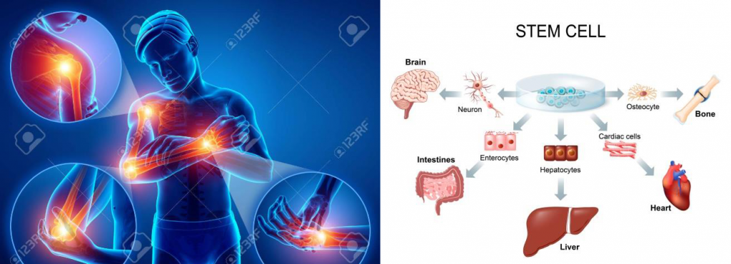 Stem Cell and PRP Joint Regeneration