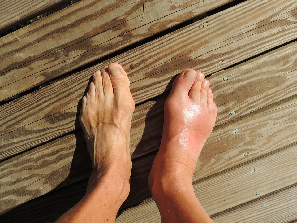 How to Manage Gout Flare-Ups
